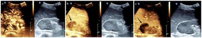 Contrast-enhanced ultrasound evaluation of primary renal squamous cell carcinoma: a case report